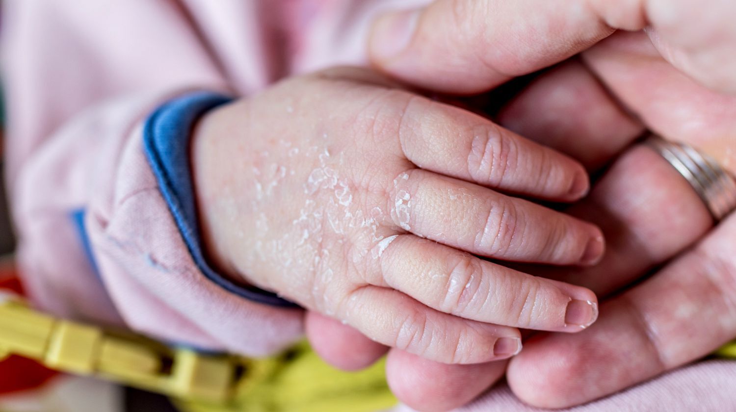 red-blotches-on-back-of-babys-head-netmums